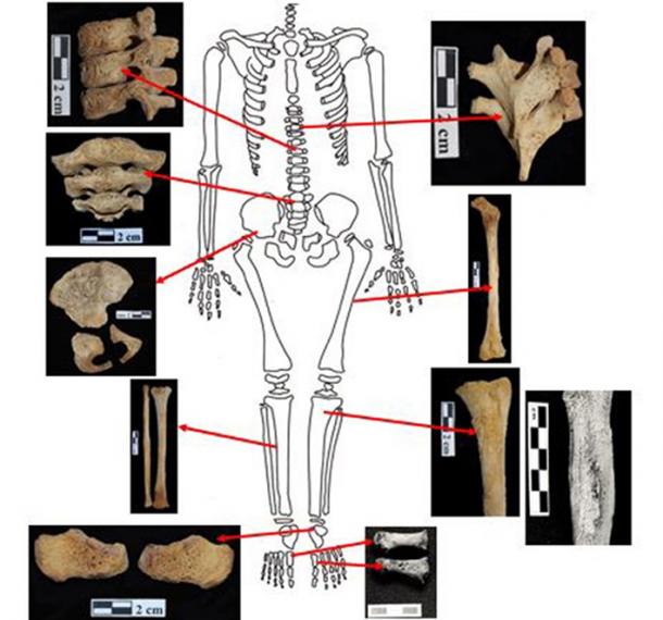 Images of the Egyptian child from the Dakhleh Oasis who was between 3 and 5 years old at death. It seems the child died of leukemia. Image credit: El Molto