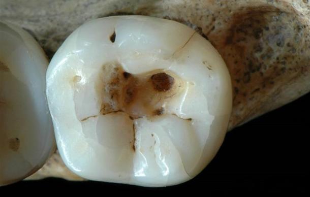Paleolithic Toothache: Oldest Dentistry Revealed