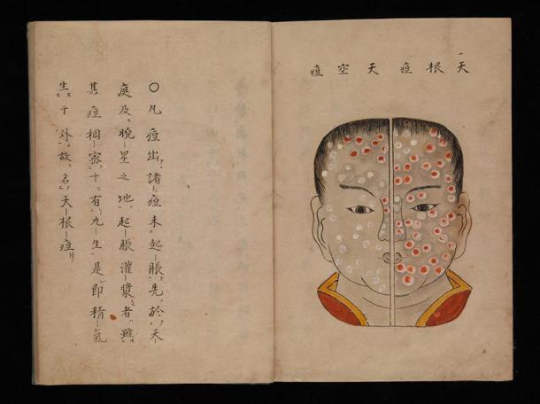 Japanese watercolor illustration of smallpox, dating back to 1720, from a work entitled Toshin seiyo, or The essentials of smallpox. (Wellcome Collection / Public Domain Mark 1.0)