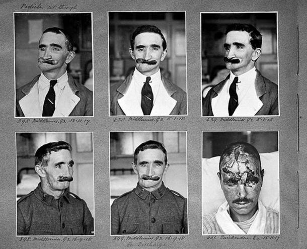 Middlemiss, facial wound, plastic surgery. (wellcomeimages.org / CC BY-SA 4.0)