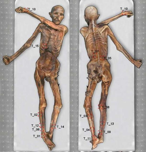 Ötzi the Iceman’s body with 61 tattoos. 