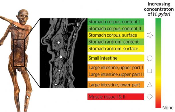 Samples taken from Ötzi’s stomach and intestines contained DNA from H. pylori, while his muscles contained no trace of the bacteria. Concentration is represented by a color gradient, starting with red (none) and increasing to green.