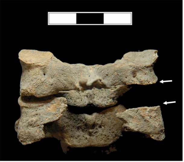 Parallel sword wounds to the back of a crusaders neck, found in the Sidon mass crusaders graves, suggesting decapitation of captives after the battle. (Richard Mikulski /PLOS One)