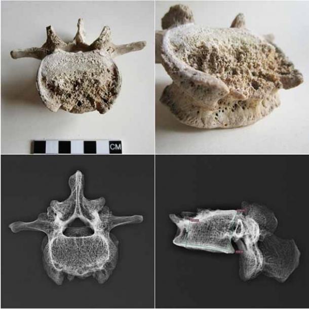 Fotografía y radiografía digital de la cuarta vértebra lumbar (L4) afectada por espondilodiscitis tuberculosa en el hombre de Pompeya. (Scorrano et al. / CC BY 4.0)