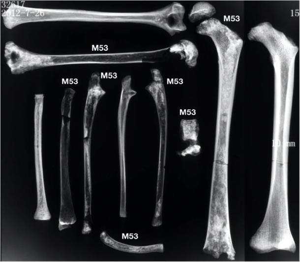 Radiographs of the long bones show osteopenia compared to a 12 year old comparative archaeological individual with non-pathological bone. (Image: CC BY 4.0)