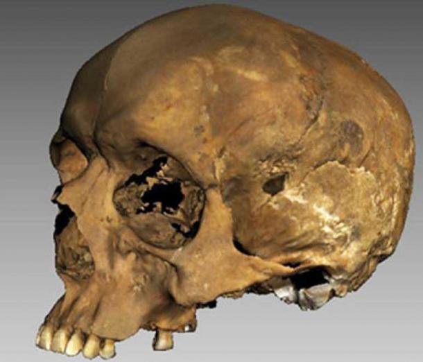 The 3d image of Richard's skull.