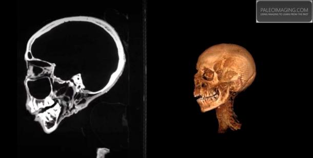 La captura de pantalla de la reconstrucción por TC producida por Paleo Imaging utilizando el visor RadiANT DICOM, reveló que el cerebro se extirpó como es habitual en las momias egipcias. (paleoimaging.com)