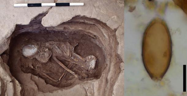 Skeleton 30928, a possible female, aged 35–50 years, dating from 6700–6500 BC. (Çatalhöyük Research Project) Microscopic egg of whipworm from Çatalhöyük, Turkey. Black scale bar represents 20 micrometres.