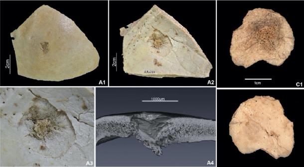 Part of the skeletons damaged by blunt objects/arrows during the massacre, which were found in the Spanish Pyrenees. (T. Schuerch / G. Schulz / Scientific Reports)