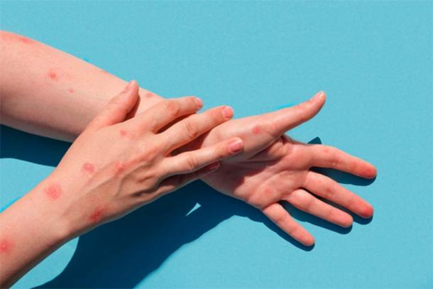 Smallpox was a deadly disease throughout history, that was eventually eradicated through vaccination. (Marina Demidiuk/Adobe Stock)