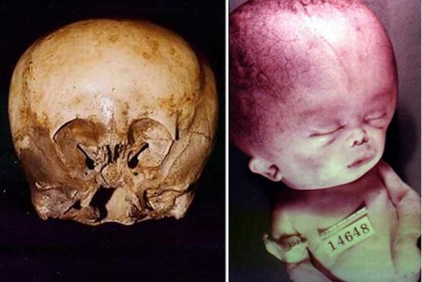 The ‘Starchild’ skull (left).(Fair Use) Photo of baby with hydrocephalus(right). (GFDL)