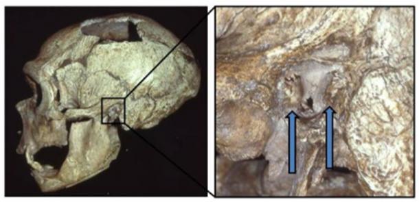 The La Chapelle-aux-Saints Neandertal skull, with the external auditory exostoses (