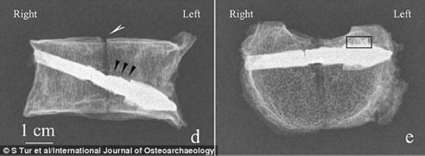 The arrow pierced the bone from above from the right to the left (Image: International Journal of Osteoarchaeology)