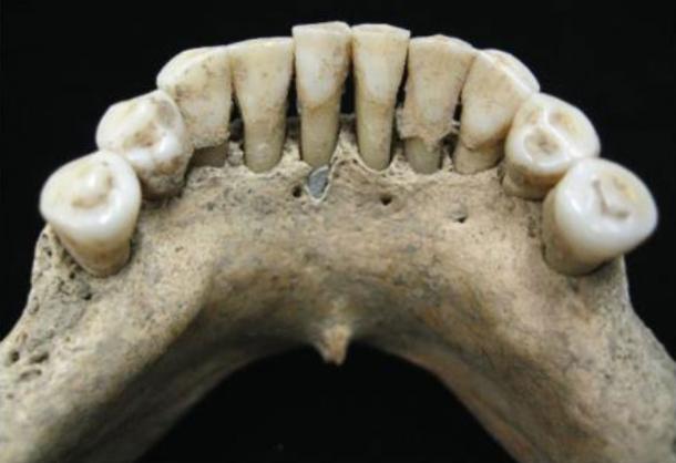 The dental sample of the female found with lapiz lazuli pigment. Image: C. Warinner, Institute for Evolutionary Medicine, University of Zürich, via Science Advances CC BY NC 4.0