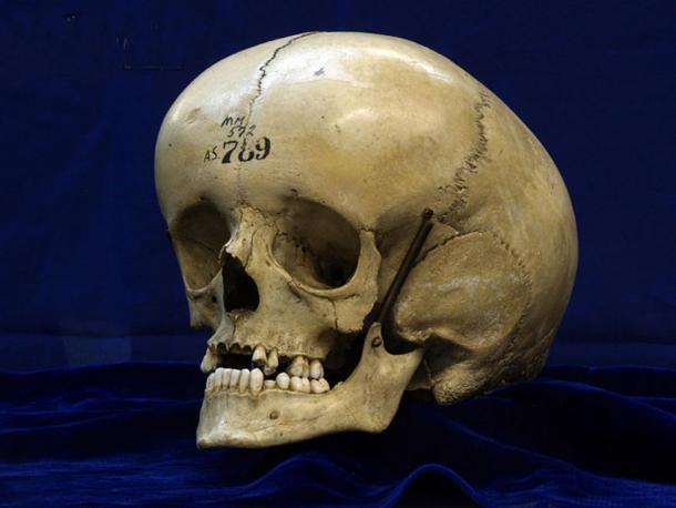 The enlarged skull of a person with hydrocephalus. (CC BY 2.0)