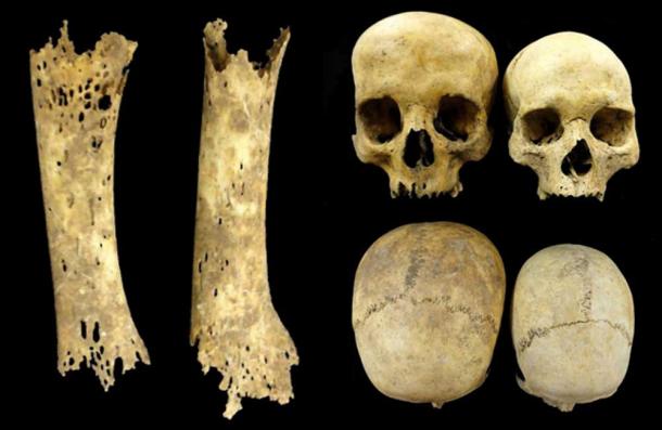 The foot bones of a teenager with syphilis (left). An enlarged skull, possibly due to hydrocephaly (right). 