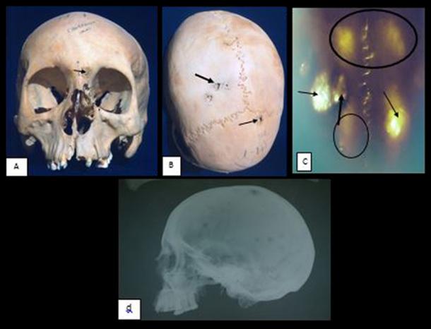 The skull of a woman in her 20s showed she suffered from a cancer that had spread to her head. She may have had the HPV virus. Image credit: El Molto