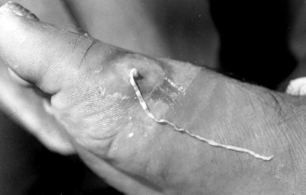 The worm after is has been partially wound out of the body with a stick. Part of the worm remains in the foot.