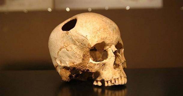 There is evidence of this kind of surgery much earlier. For example, this trepanned skull of a girl who lived 5,500 years ago. She survived the surgery. Natural History Museum, Lausanne ( CC BY SA 2.0 )
