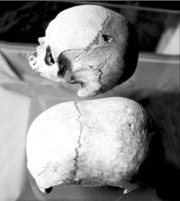 Two of Malta’s mysterious skulls, the dolichocephalous (long-headed) one below. (Adriano Forgione)
