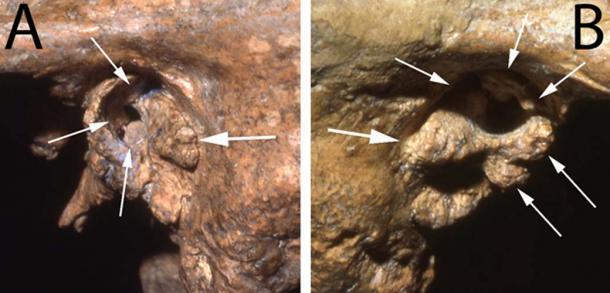 Two views of the ear canal of the Neanderthal fossil Shanidar 1 showing deformities likely to have caused profound deafness. (Image: Courtesy of Erik Trinkaus)