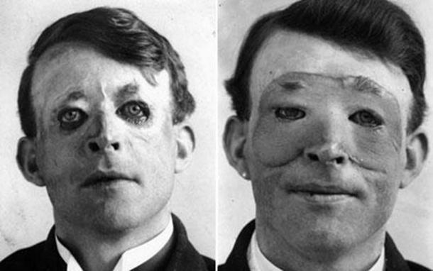 Walter Yeo, the first person to receive plastic surgery, before (left) and after (right) skin flap surgery performed by Sir Harold Delf Gillies in 1917. In the tragic accident he was recorded as having lost both his upper and lower eyelids. The surgery was some of the first to use a skin flap from an unaffected area of the body and paved the way for a sudden rash of improvements in this field. (Daily Telegraph / Public Domain)