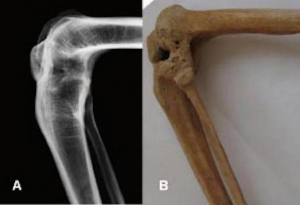 X-ray and photograph of the flexed ankylosed left knee of the prosthesis owner. 
