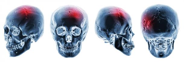 It is believed that a person’s special abilities from genetic memory can appear after significant trauma to the brain has occurred. Pictured X-rays of human skulls with apparent head trauma. (stockdevil / Adobe stock)