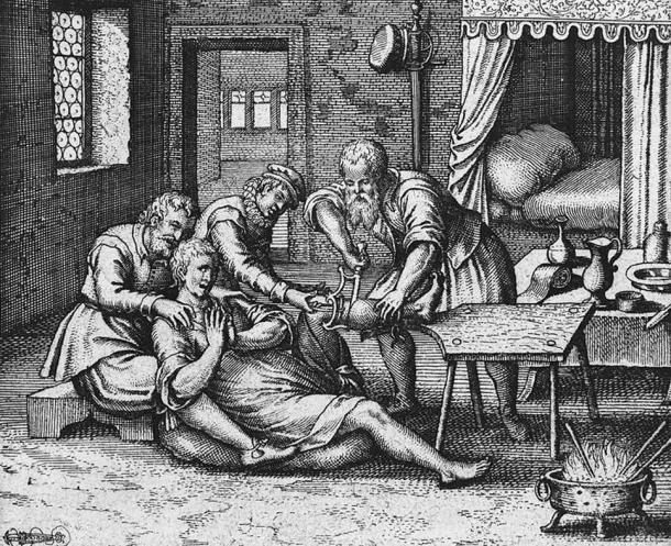 17th century illustration of an amputation scene