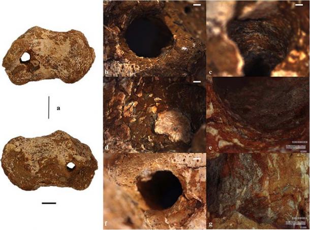 Right calcaneus from 1st c AD Gavello, Italy, showing possible evidence of crucifixion. This archaeological evidence has provided new clues to the death of Jesus. (Emanuela Gualdi-Russo & Ursula Thun Hohenstein / University of Ferrara)