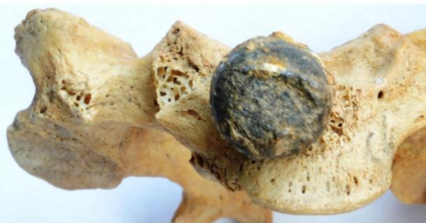 Skeleton 2: cervical vertebra with the musket ball that produced the injury
