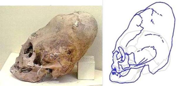 A “cone-head” type of skull. (Lumir G. Janku)