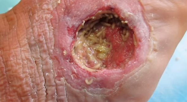 Terapia de desbridamiento de gusanos en una herida de pie diabético. (CC por SA 3.0)