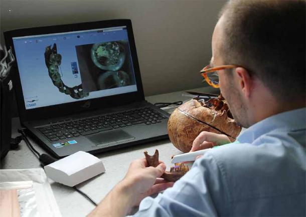 The team of dentists scanned Anne d’Alegre’s skull to reveal the way gold wire was used to hold her teeth together. (Rozenn Collator / Inrap)