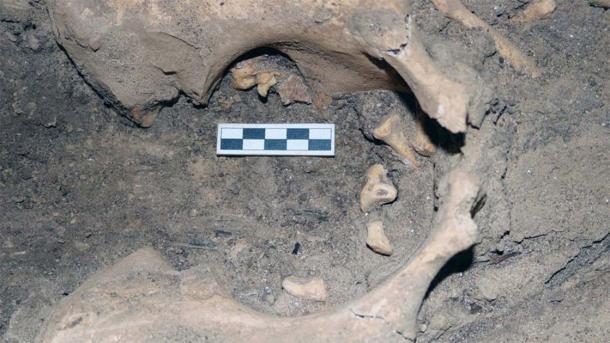 The teratoma tumor depicted in situ within the left sciatic notch which was discovered inside the Amarna burial. (M. Wetzel / Amarna Project)