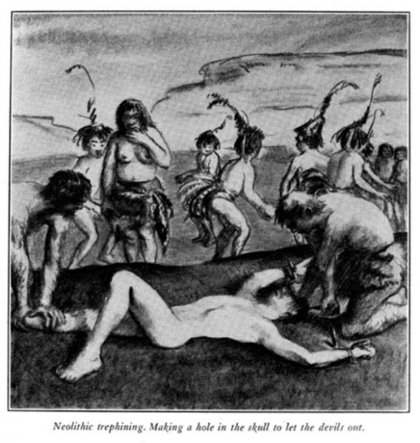 Example of art depicting prehistoric trepanation. Was it really so primitive? 