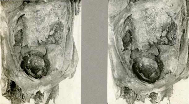 Archaeologists discovered an infant's head within the pelvic region of a mummified female who died during childbirth in ancient Egypt. The team posits that the baby was in a breech position, leading to an accidental decapitation. (Francine Margolis, David R. Hunt/onlinelibrary.wiley.com)