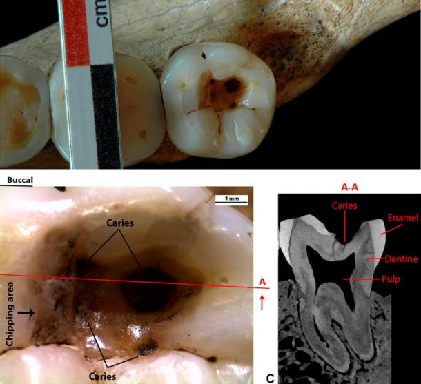 El área de la cavidad del diente parcialmente vaciada es visible, con astillas en la pared izquierda. La imagen superior muestra un claro desgaste del esmalte dental.