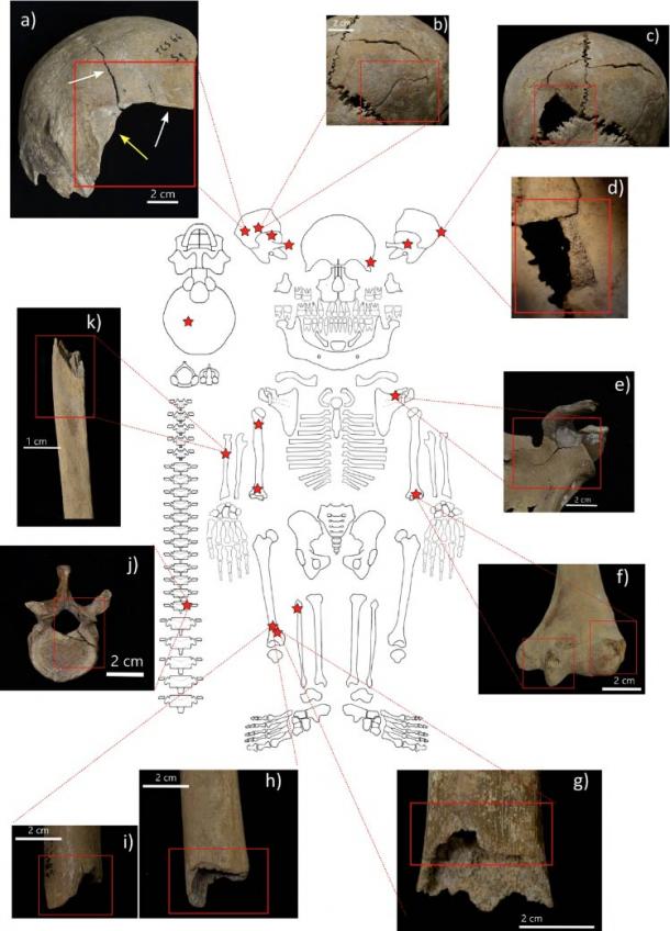 Distribution and examples of perimortem skeletal lesions at Cornaux/Les Sauges