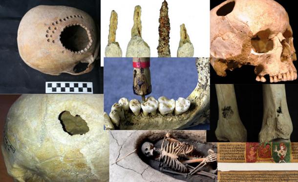 Eight Impressive but Terrifying Cases of Ancient Surgery