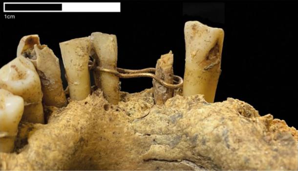 Gold wire ligature on the mandible of the medieval man found at St Nicholas Kirk, Aberdeen