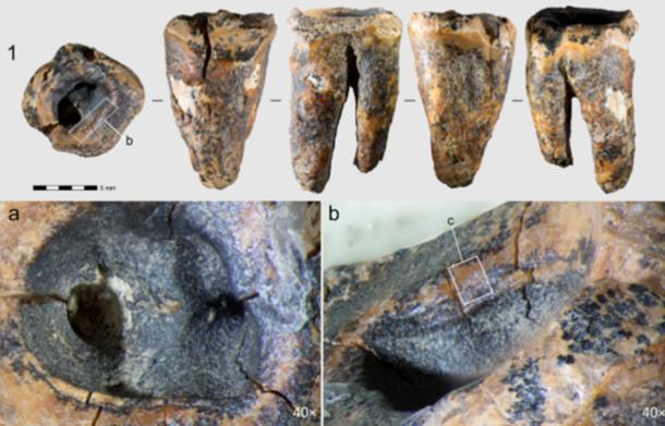 Chagyrskaya 64 molar tooth showing the drilled cavity evidence of Neanderthal Dentistry