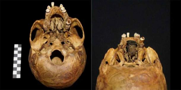 The skull of the man found in Poland from behind. On the left the absence of a hard palate can be clearly seen. The photograph on the right shows how the gold prosthesis was fitted. Source: Anna Spinek; © 2024 Elsevier Ltd / Live Science.