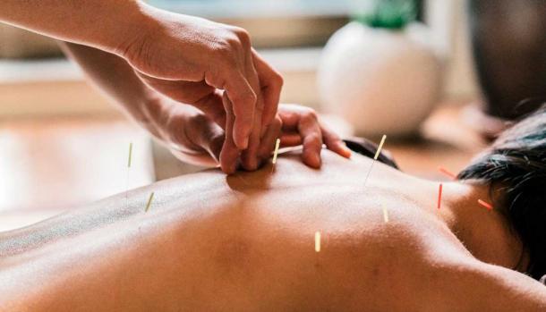 Therapist giving acupuncture to a woman. Source: juripozzi / Adobe Stock