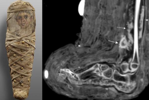 On the left, photograph of ancient Egyptian child mummy from Tomb of Aline, discovered in Hawara. On the right, CT scan of soft tissue infection in the lower leg, showing a mass consistent with dried pus. Source: Panzer et. al / International Journal of Paleopathology