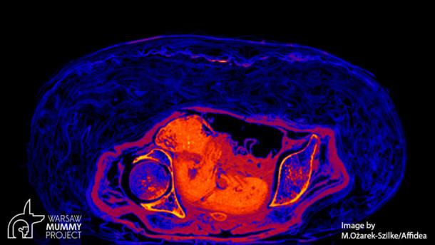 Scan of the mummified fetus discovered within the pregnant mummy. Source: Warsaw Mummy Project