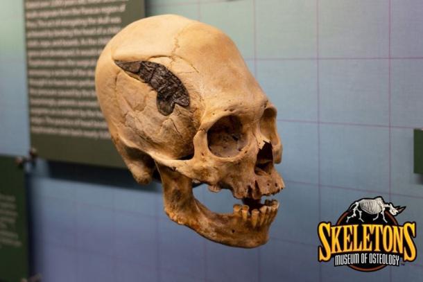 The elongated skull of a Peruvian warrior who underwent skull surgery 2,000 years ago. Source: Museum of Osteology