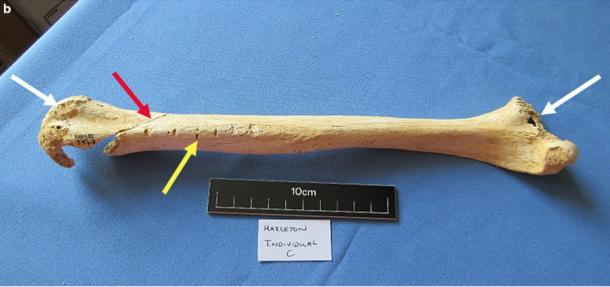 Right humerus from Individual C of the Hazleton North Neolithic tomb, showing helical fracture (red arrow), tooth marks (yellow arrow) and gnawed proximal and distal ends (white arrows). (Reich et al. Nature)