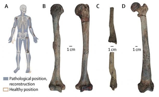 Los paleontólogos que analizan los restos de un hombre neolítico desenterrados en Maliq, Albania, han descubierto que padecía una enfermedad conocida como osteopetrosis, también conocida como enfermedad de los huesos de piedra. (Gresky et al. / The Lancet Diabetes and Endocrinology)