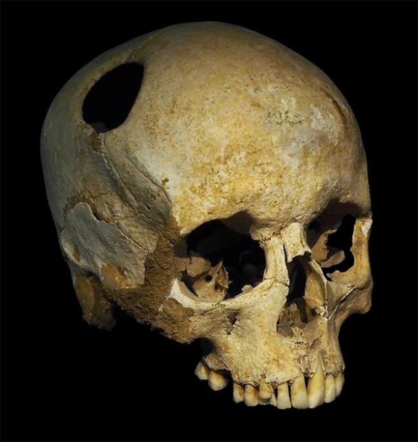 The perimeter of the trephination hole in this Neolithic skull is rounded off by ingrowth of new bony tissue, indicating that the patient survived the operation. This skull was discovered in Corseaux, Switzerland. (Rama / CC BY-SA 3.0 FR)